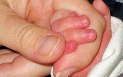 Trẻ bị cước tay chân: Mẹo chữa trị hiệu quả